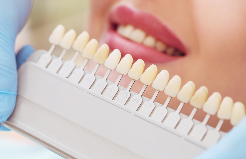 Unsere Techniker passen Ihre Zahnfarbe perfekt an.